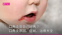 口角炎會自己好嗎？口角炎原因、症狀、治療