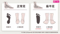 扁平足-扁平足當兵-扁平足矯正-扁平足會