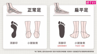 扁平足-扁平足當兵-扁平足矯正-扁平足會