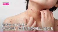 濕疹