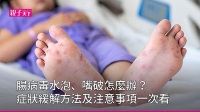 腸病毒-水泡-治療